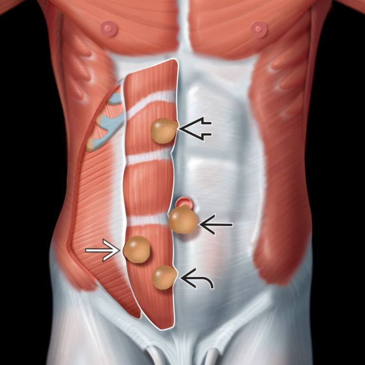 Abdominal Wall Hernia Radiology Key