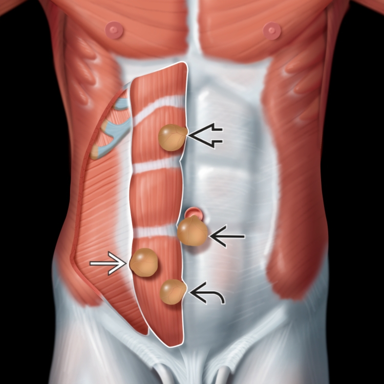 Abdominal Wall Hernia Radiology Key Abdominal Wall Hernia Radiology Key