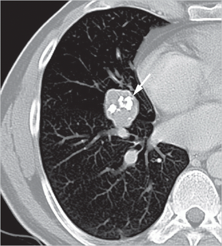 Tumors Of The Lung Radiology Key