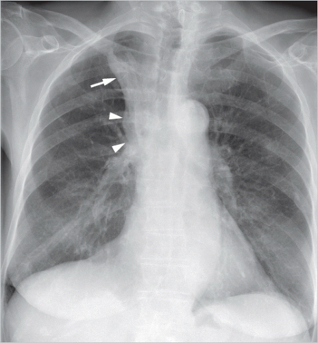 Tumors Of The Lung Radiology Key