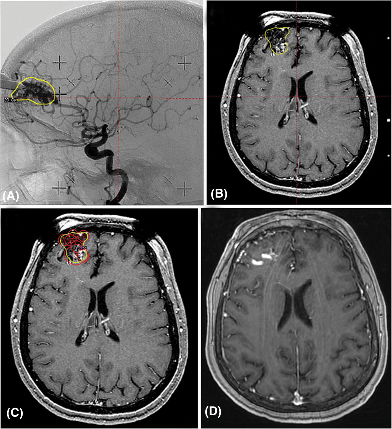 Gamma Knife radiosurgery for acromegaly: Evaluating the role of