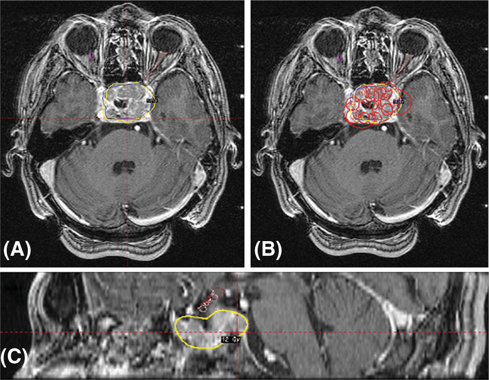 Gamma Knife radiosurgery for acromegaly: Evaluating the role of