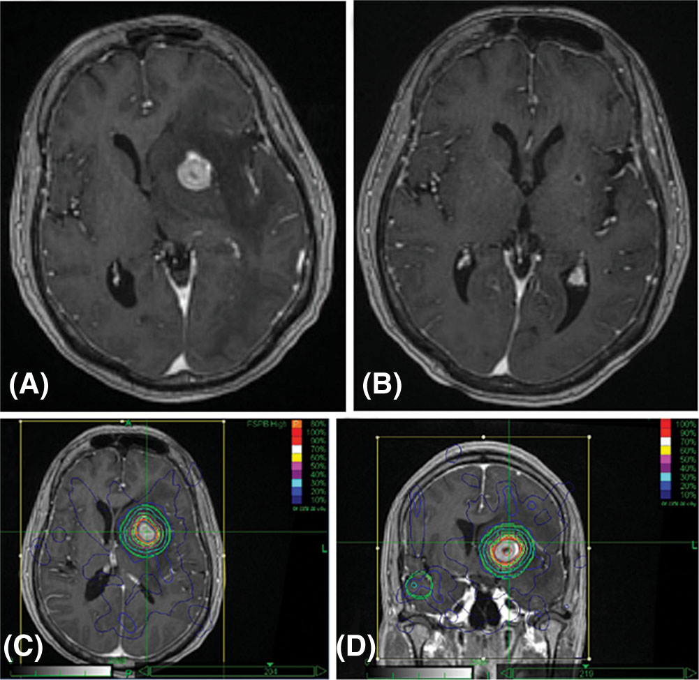 Gamma Knife radiosurgery for acromegaly: Evaluating the role of