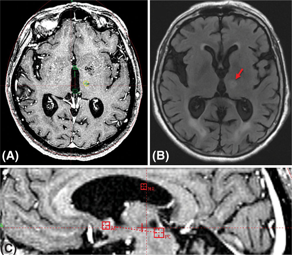 Gamma Knife radiosurgery for acromegaly: Evaluating the role of