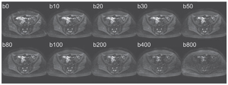 marrow ivim mri