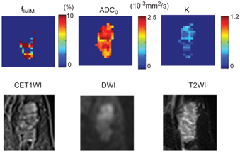 Example of ADC 0 map of breasts pre-and post-breastfeeding. 36-year-old