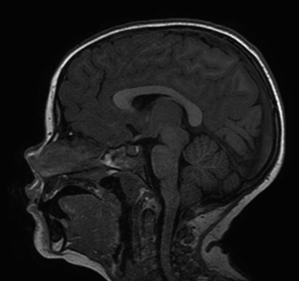 normal cerebellar tonsils