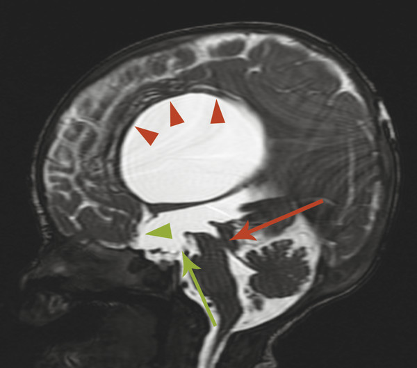 hydrocephalus mri