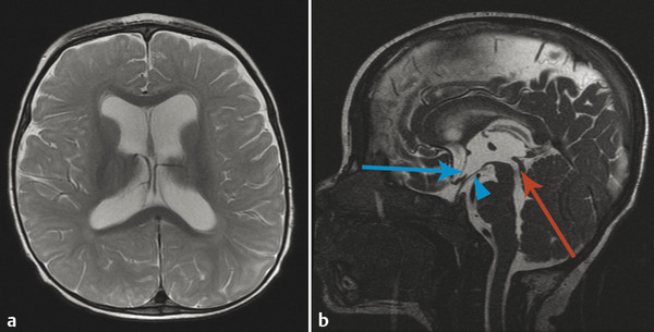 11 Hydrocephalus Radiology Key