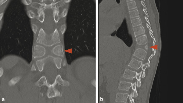 Computed tomography scan of the dorso-lumbar spine showing no fracture