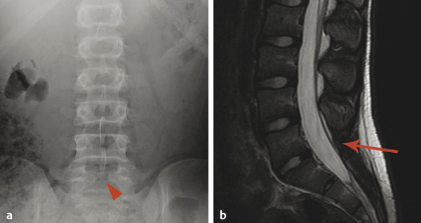 spina bifida occulta x ray