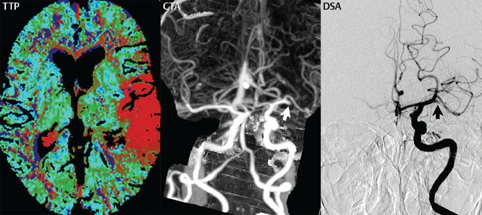 PICA infarct, Radiology Case