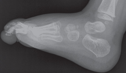 File:X-ray of a normal foot of a 12 year old male - lateral.jpg
