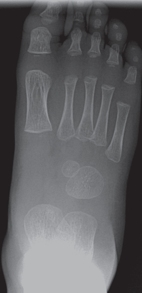 Normal foot x-ray - 2-year-old, Radiology Case