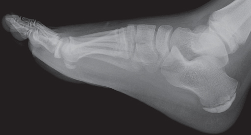 File:X-ray of a normal foot of a 12 year old male - lateral.jpg - Wikimedia  Commons