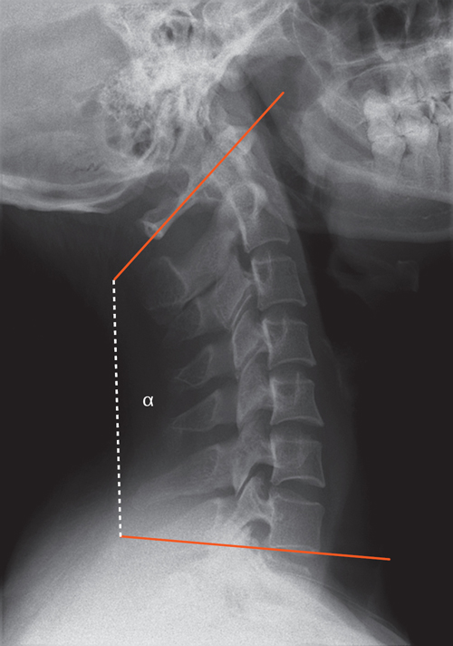 Typical thoracic vertebrae, Radiology Reference Article