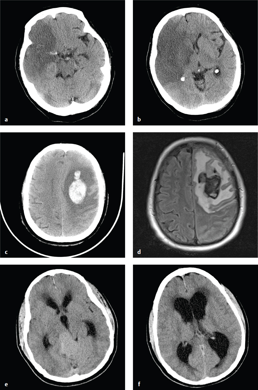 Venous vascular territories of the lateral cerebral cortex (illustration), Radiology Case