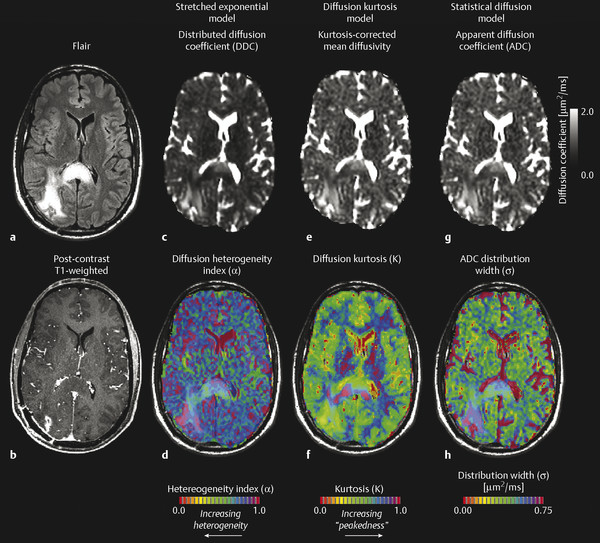 8 Diffusion Weighted Imaging For Gliomas Radiology Key 3406