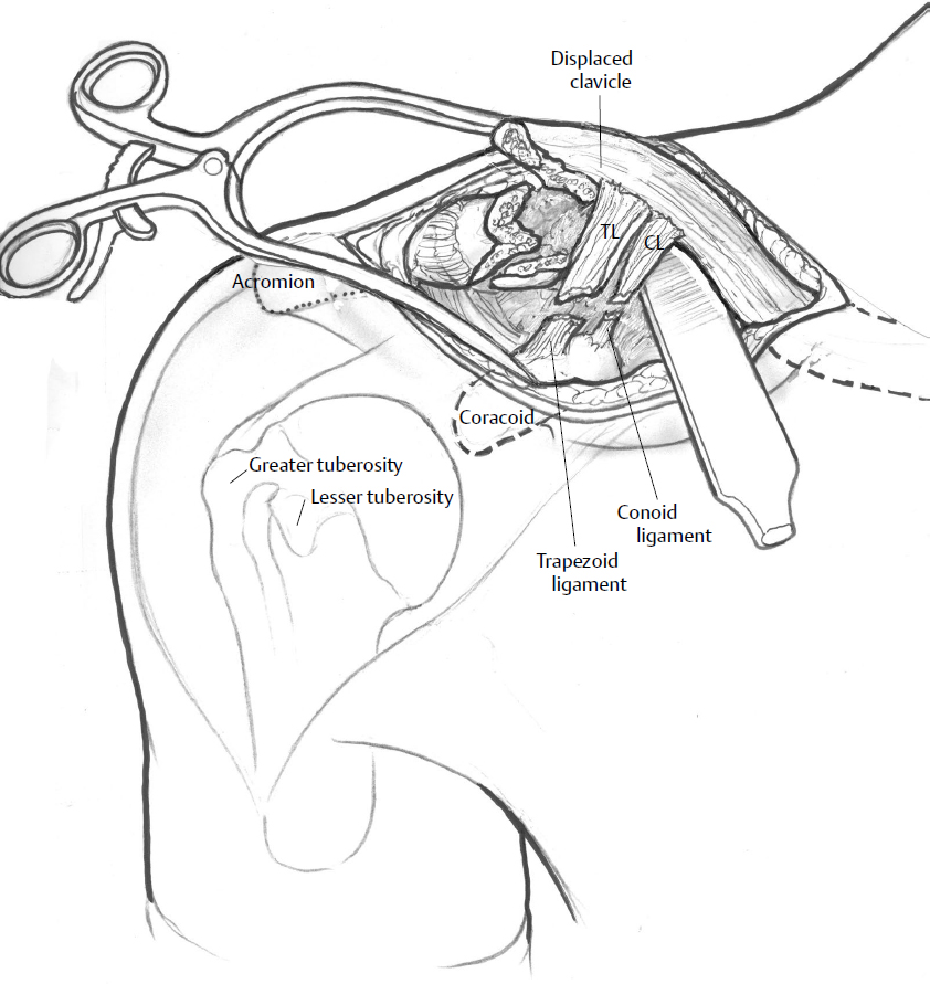 Pushing lump inferiorly produces concavity of the overlying skin (arrows)