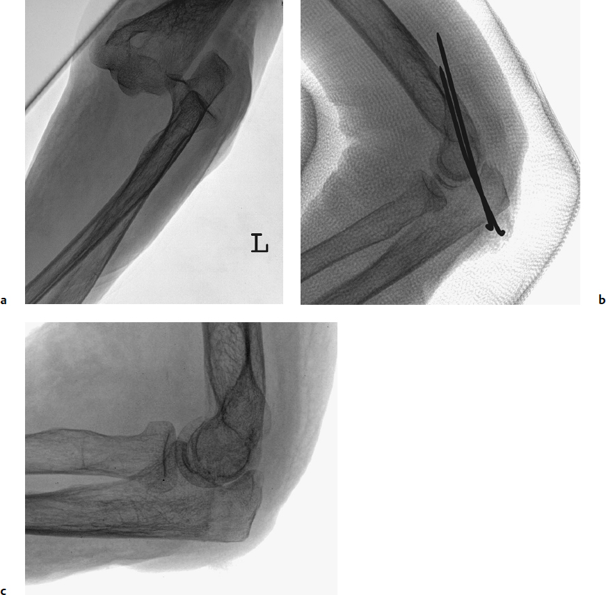 Icd 10 Code For Contusion Right Elbow And Arm