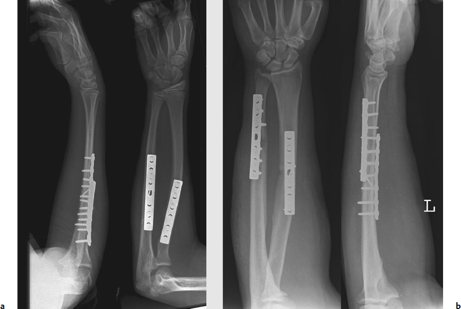 Forearm Fractures Radiology Key