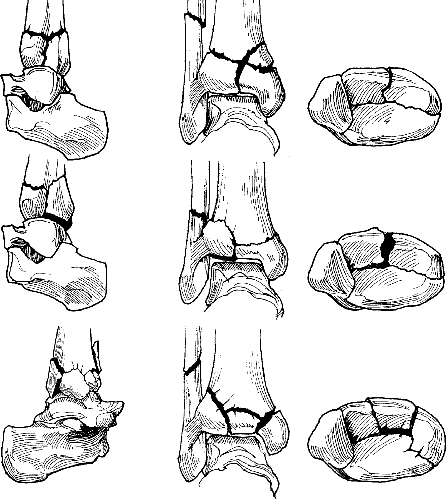 AO/OTA classification of tibial diaphyseal fractures. 9