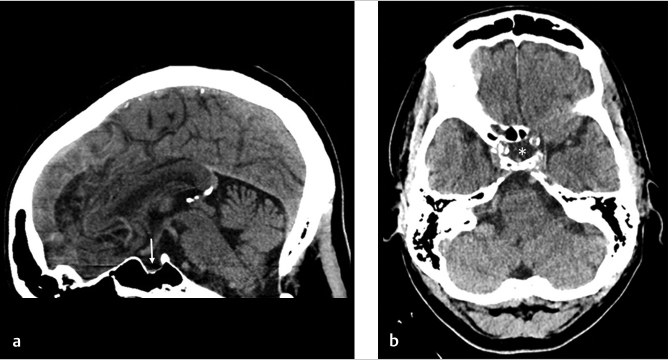 7-empty-sella-configuration-radiology-key