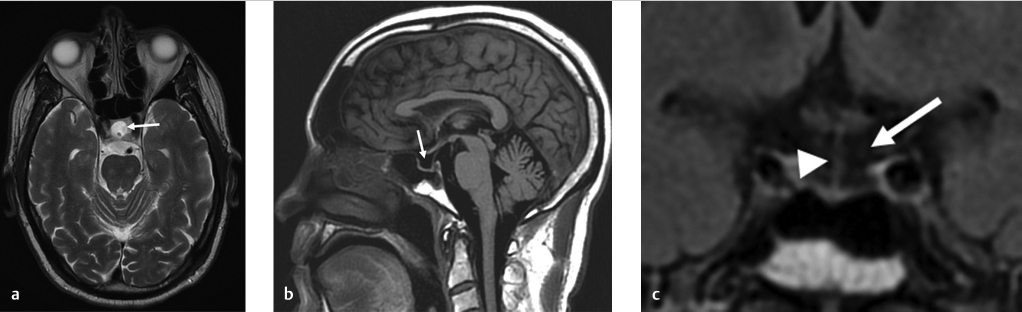 7-empty-sella-configuration-radiology-key