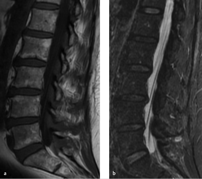 28 Diffusely Abnormal Marrow Signal within the Vertebrae on MRI 