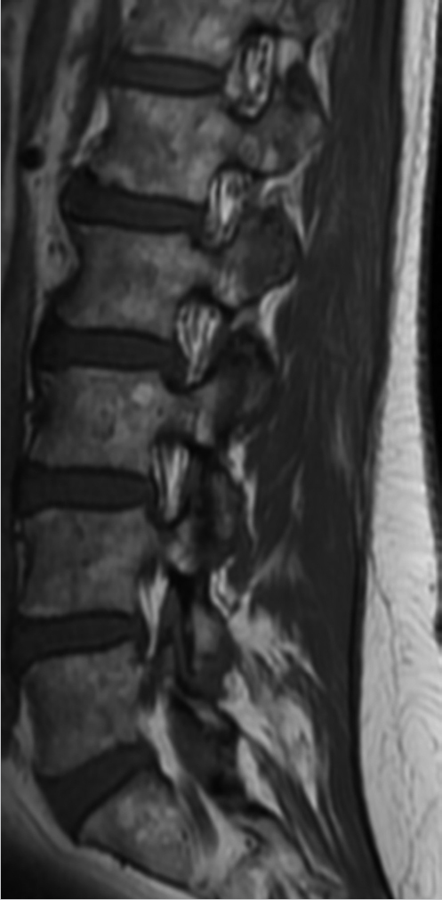 28 Diffusely Abnormal Marrow Signal within the Vertebrae on MRI 