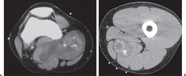 11 Soft Tissue Disease Radiology Key