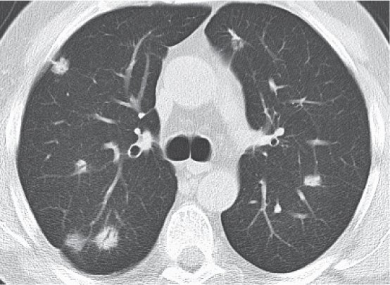 16 Lungs  Radiology Key
