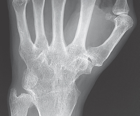 rheumatoid arthritis radiology stages