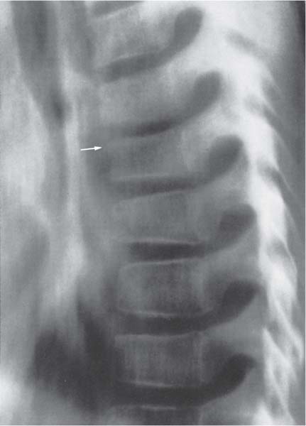 Paediatric Sacral Wedge