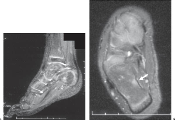 Bone Marrow Patterns | Radiology Key