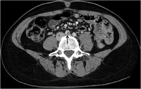 venogram venous occlusive disease