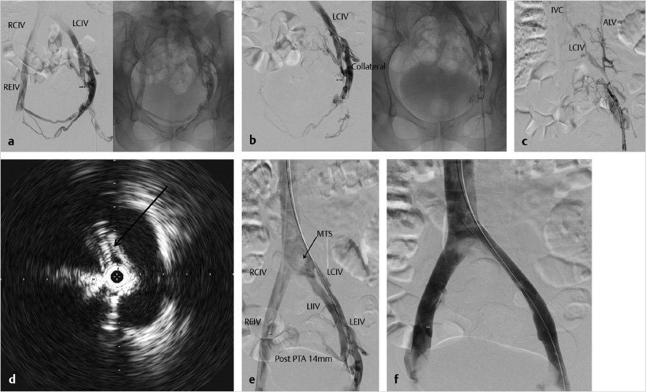 venogram venous occlusive disease