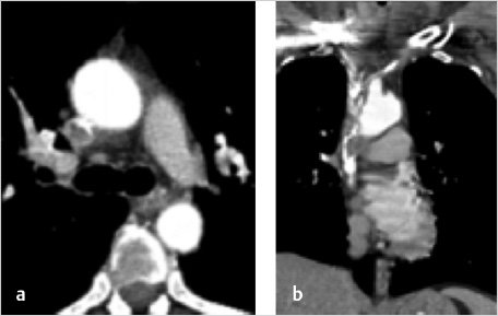 Port A Cath  Imaging And Interventional Specialists