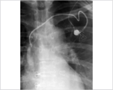 d : Case 1: The catheter is withdrawn, repositioning the chemo port tip