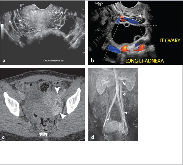 What is Pelvic Venous Congestion Syndrome? (Failures Observed in