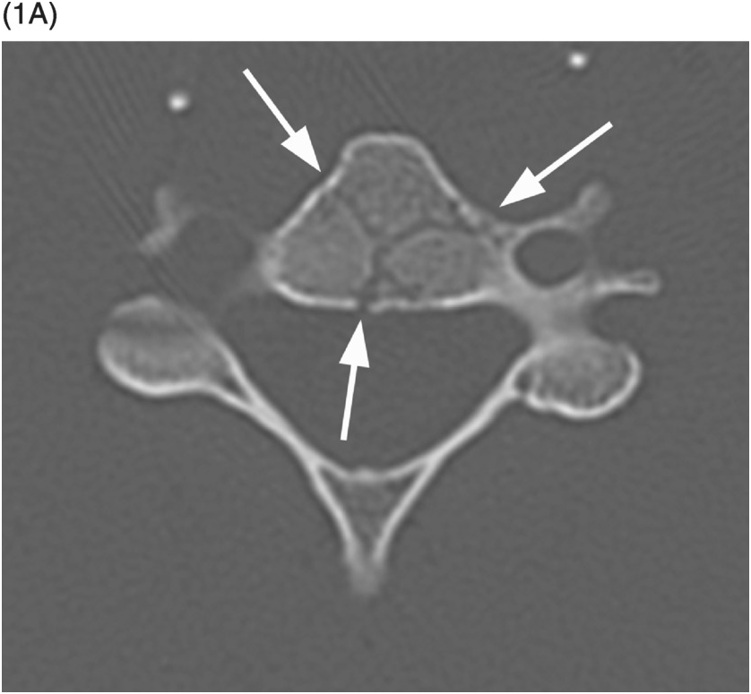 Section 1 Normal Variants and Mimickers Radiology Key