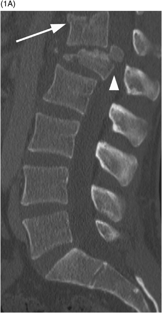 Thoracolumbar Burst Fractures Fractures Radiology Ct Vrogue Co