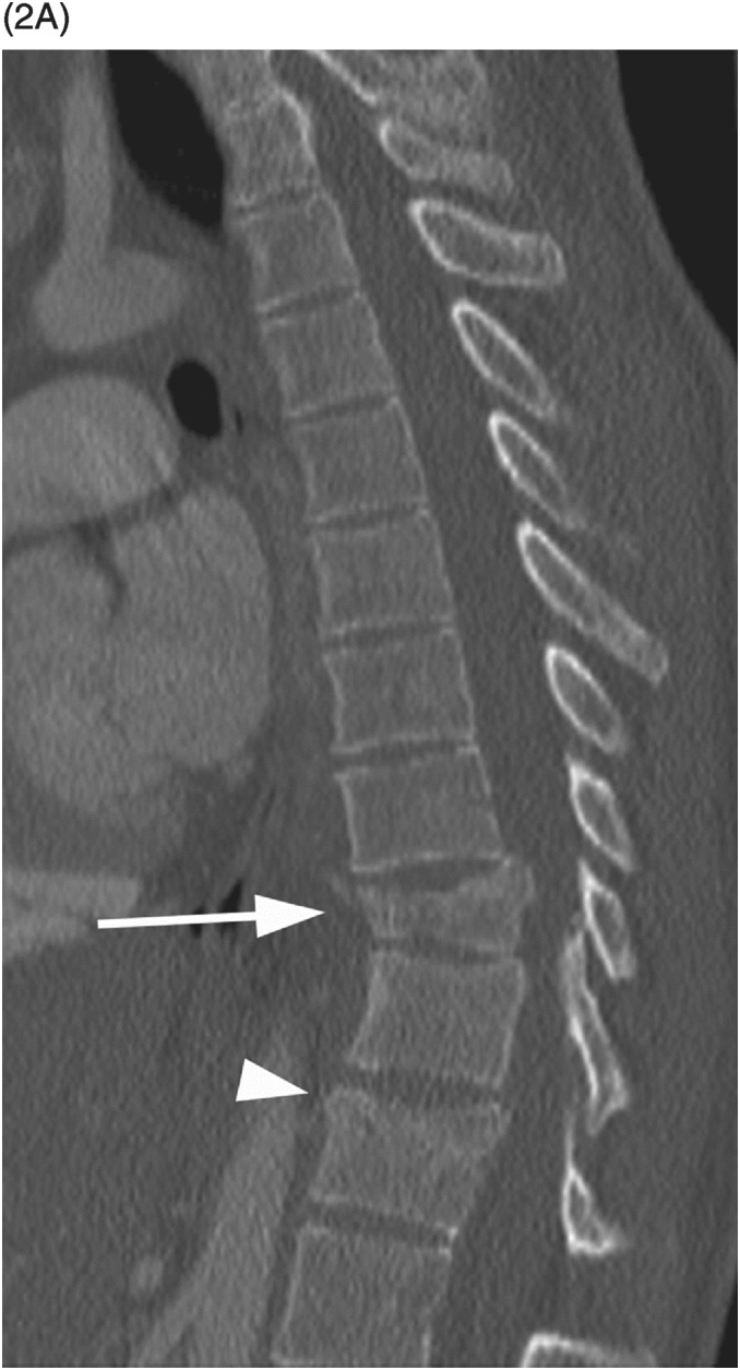 Section Thoracolumbar Trauma Classification Radiology Key