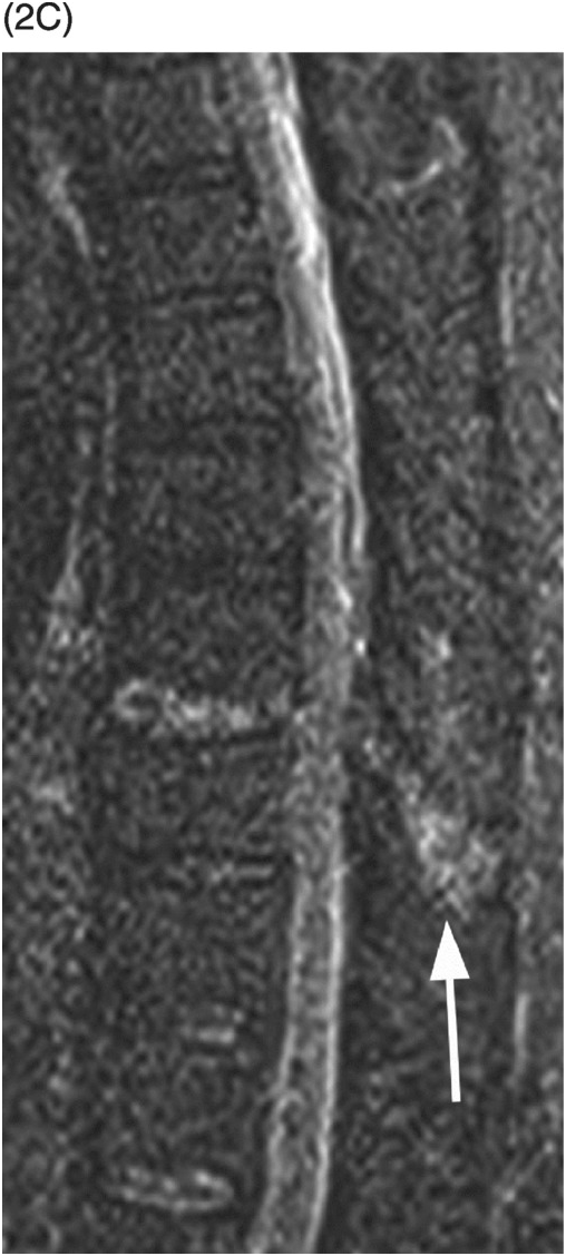 Section Thoracolumbar Trauma Classification Radiology Key