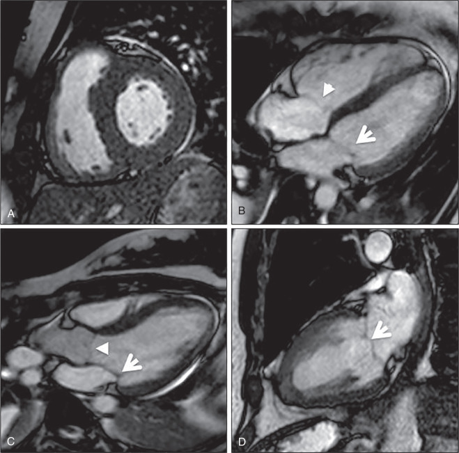 black blood mri