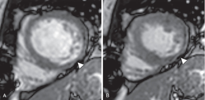 cardiac-mri-scan-shows-a-heart-beat-in-high-resolution-ecg-gated-cmri