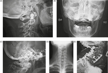 Doctors Removed a Metal Braces Wire That Was in a Woman's Intestines for 10  Years