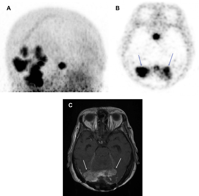 Molecular Imaging In The Head And Neck Radiology Key