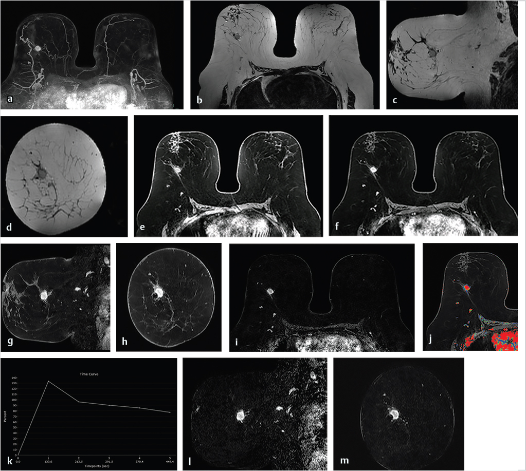 Breast MRI enhancement curves, Radiology Reference Article