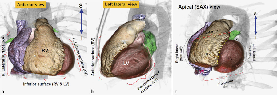 12 General Anatomy Of The Heart Radiology Key
